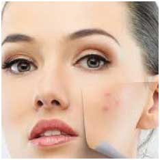 acne-pimples